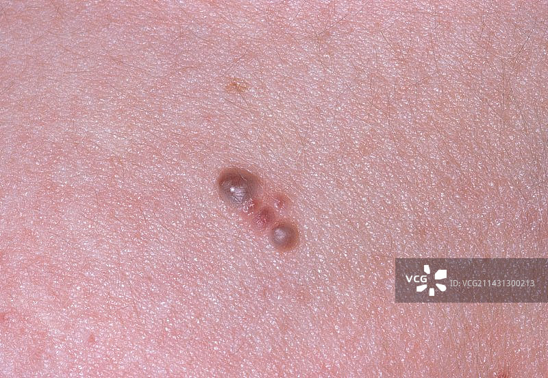 皮肤淋巴管瘤特写图片素材