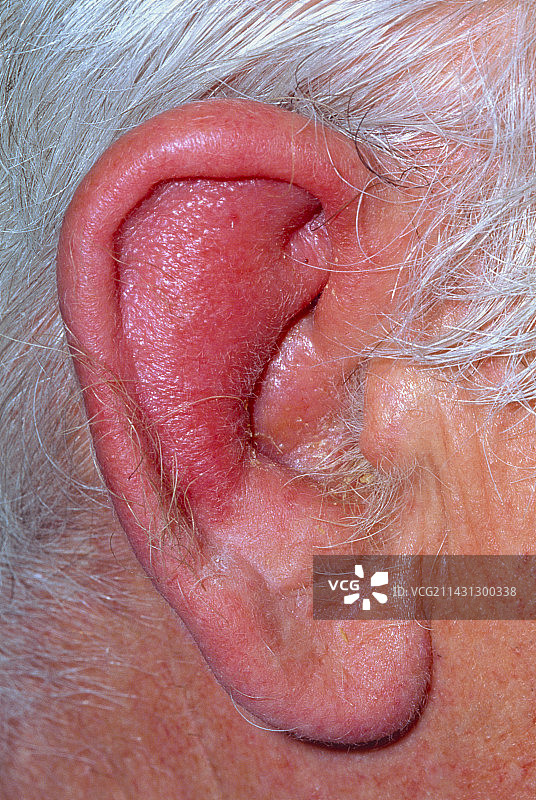 患有软骨膜炎的老年男性发炎的耳朵图片素材