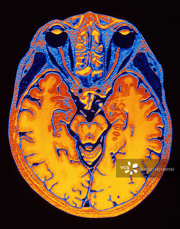 MRI脑部扫描图片素材