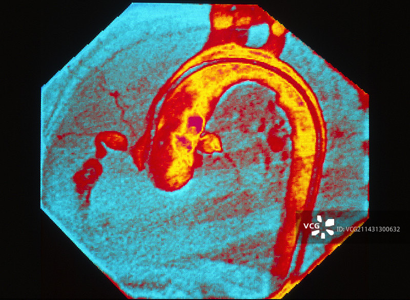 川崎病冠状动脉的彩色X光片图片素材