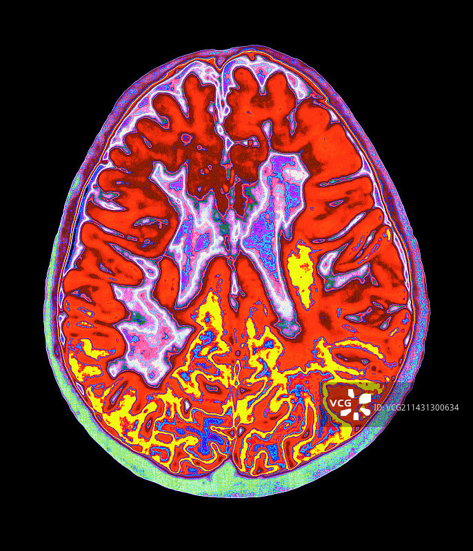 多发性硬化症大脑核磁共振扫描图片素材
