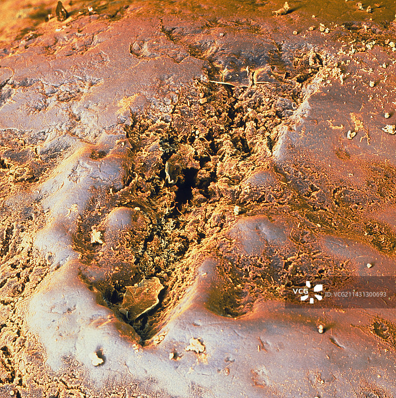 牙齿龋洞形成的彩色扫描电镜图图片素材