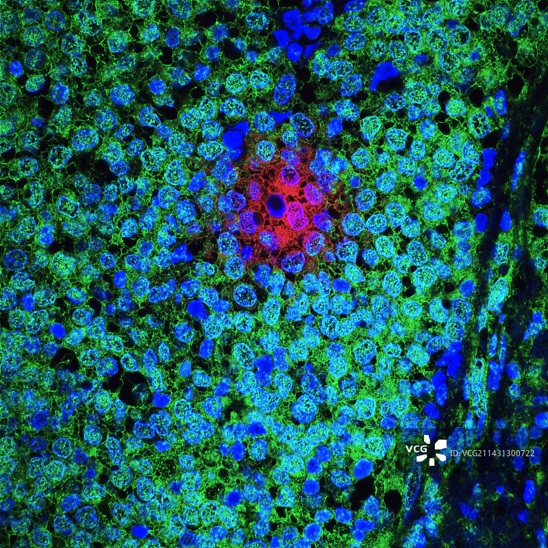 难治性乳腺癌细胞图片素材