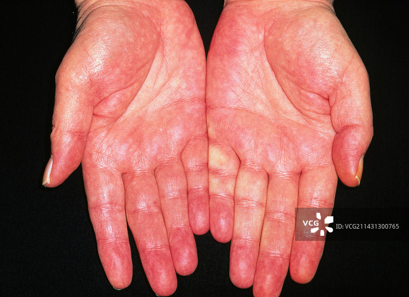 成年酒精中毒者的肝掌红斑图片素材