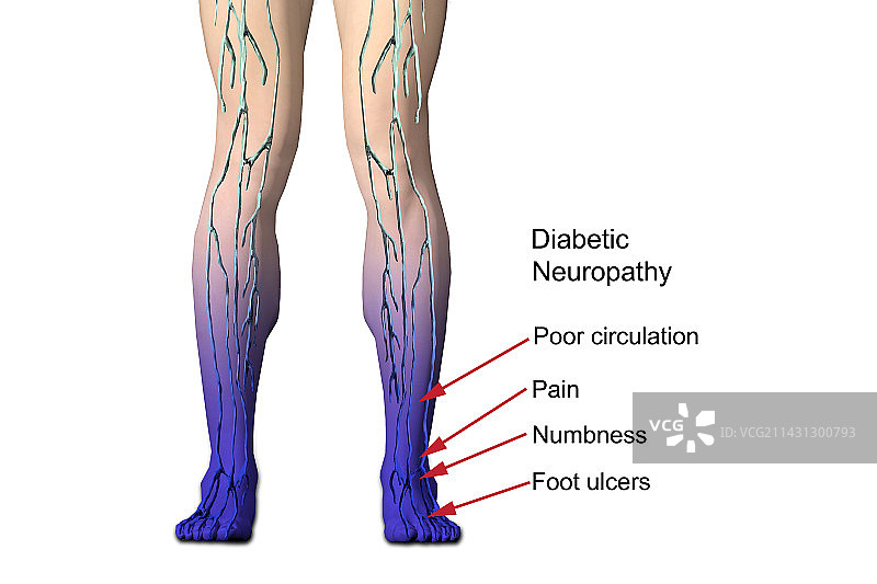 糖尿病神经病变插画图片素材