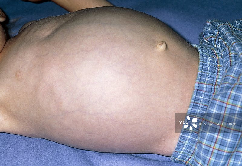 癌性肝肿大腹部肿胀图片素材