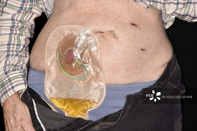 膀胱切除术后的回肠导管尿流改道图片素材