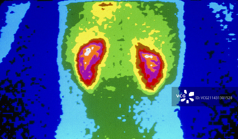 健康人肾脏的伽马射线扫描图片素材