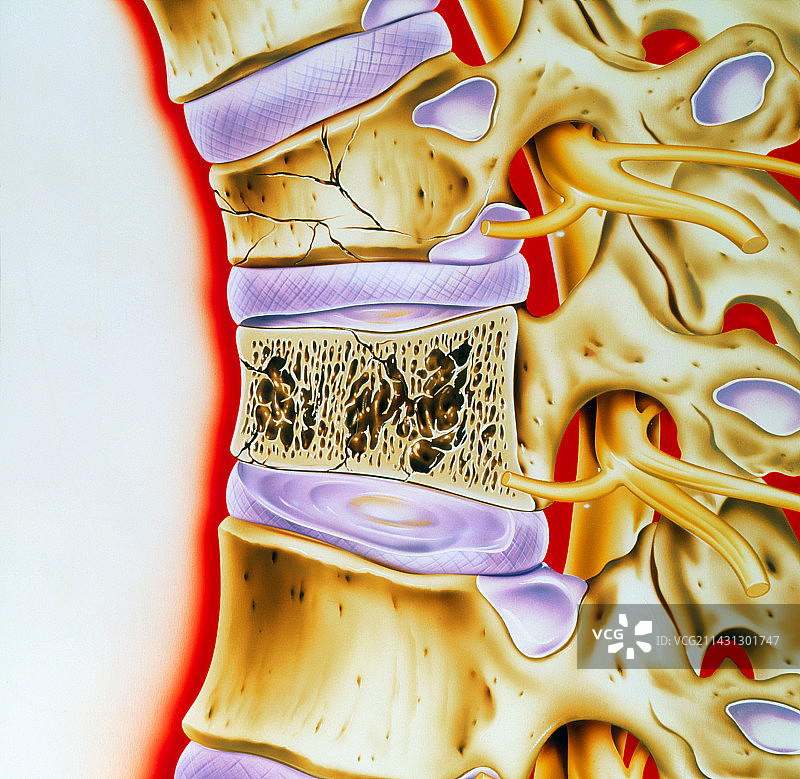 骨质疏松症脊柱图片素材