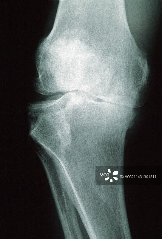 膝关节骨关节炎图片素材