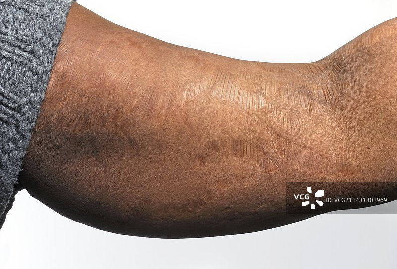 皮肤纹图片素材