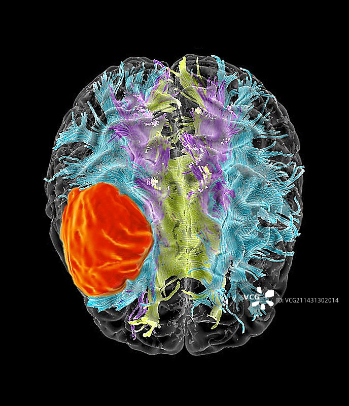 胶质母细胞瘤脑癌DTI核磁共振扫描图片素材