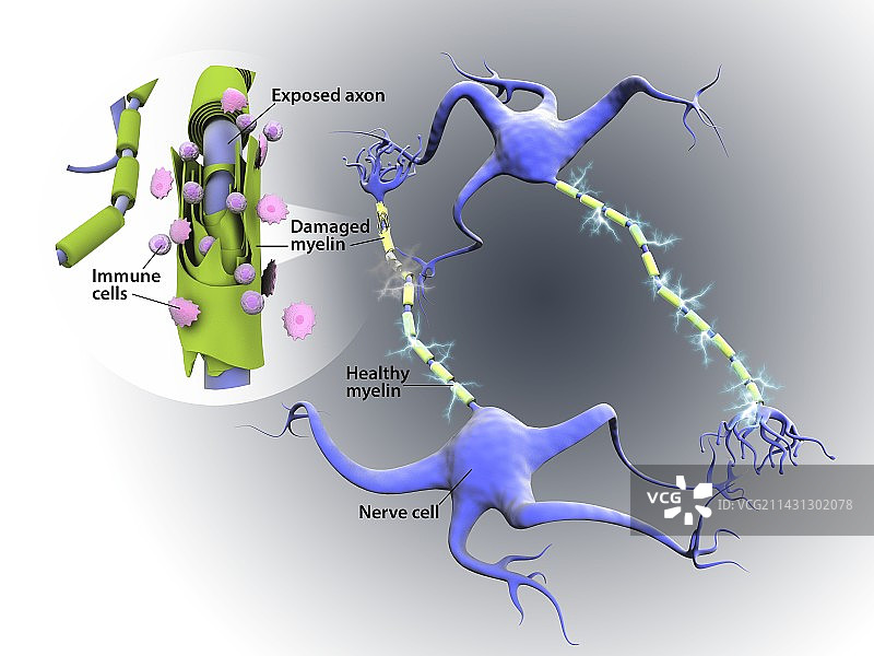 多发性硬化症中的神经损伤图片素材