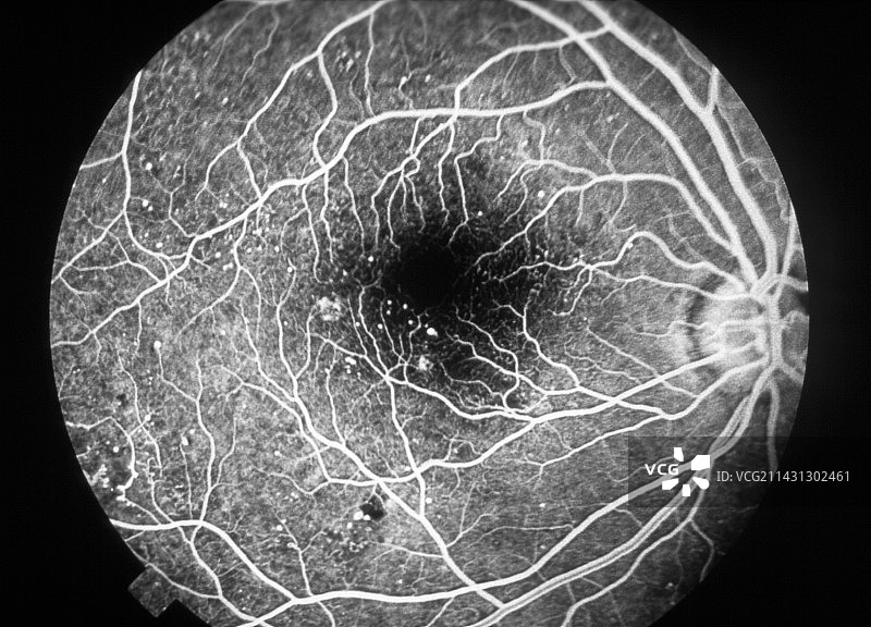 糖尿病视网膜病变荧光素血管造影图片素材
