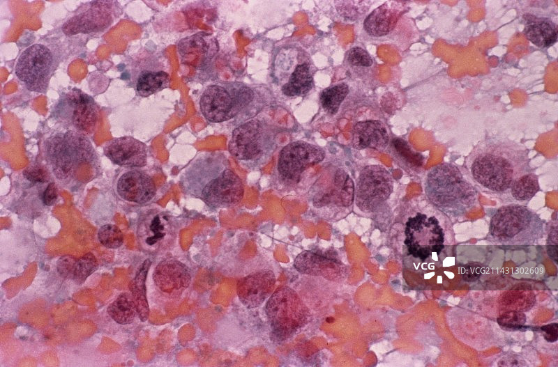 显示子宫内膜癌的宫颈涂片图片素材
