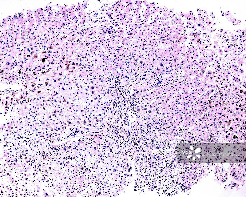肝脏血色素沉着症浅显显微照片图片素材