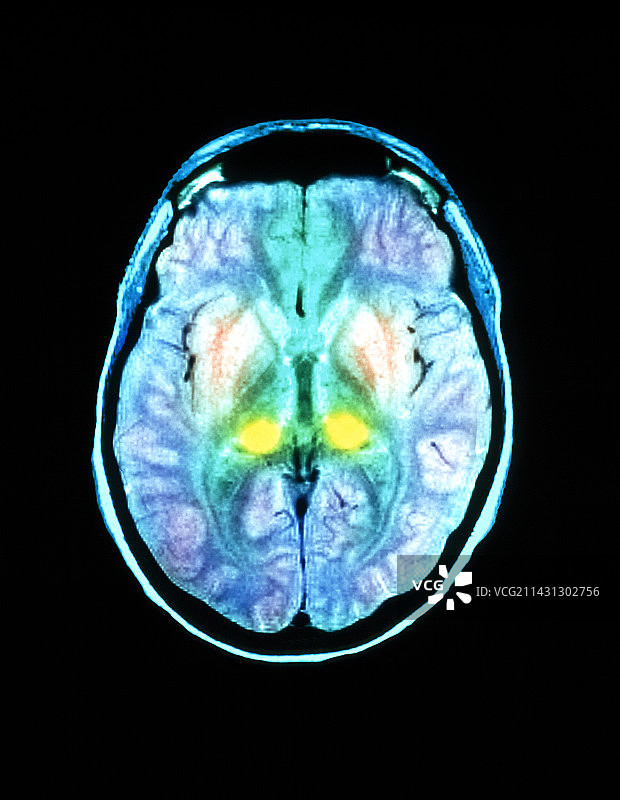 CJD脑部核磁共振扫描图片素材