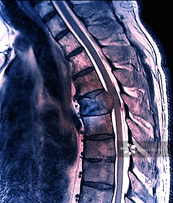 脊柱继发性骨癌的MRI扫描图片素材