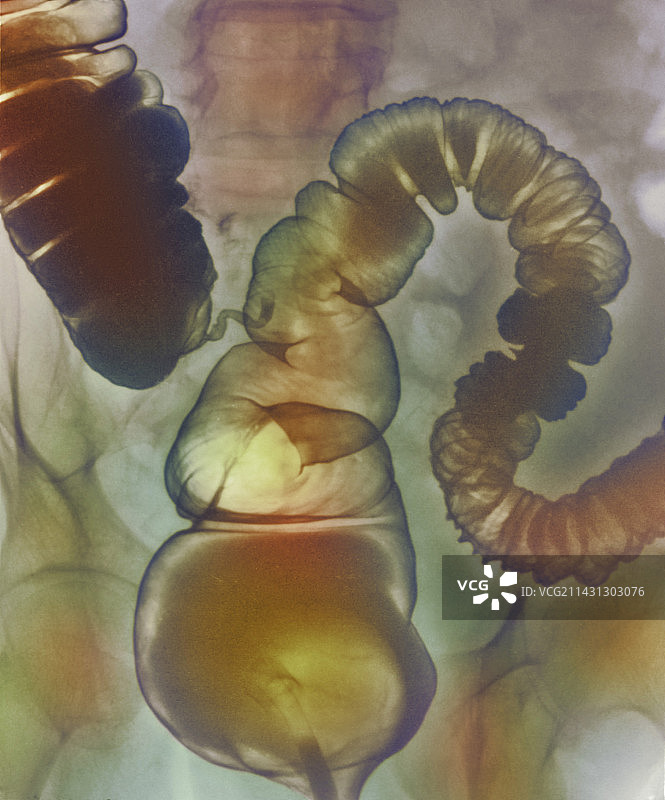肠易激综合征X光片图片素材