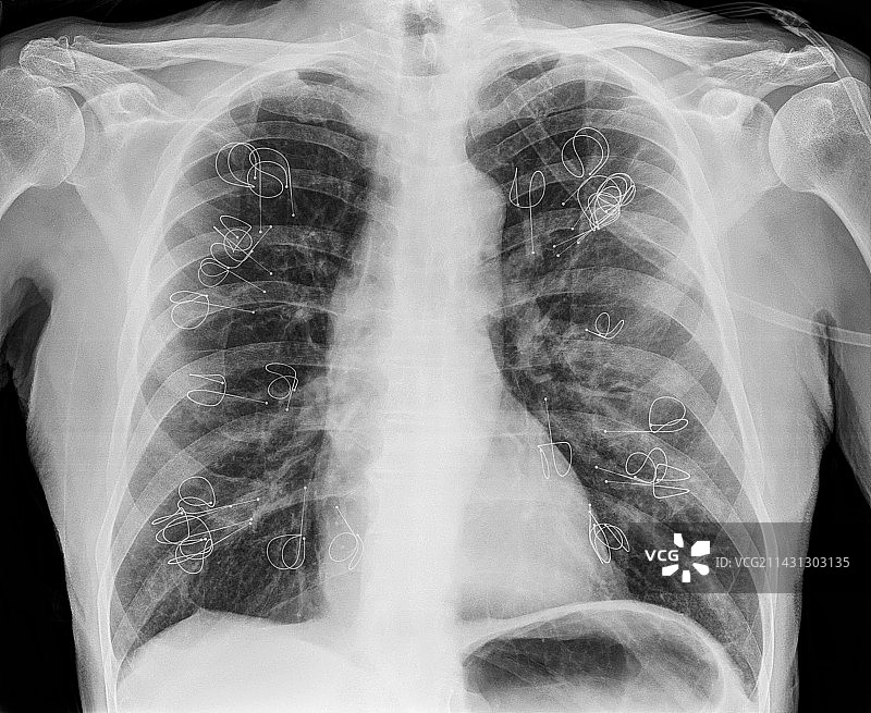 肺减容线圈植入X光片图片素材