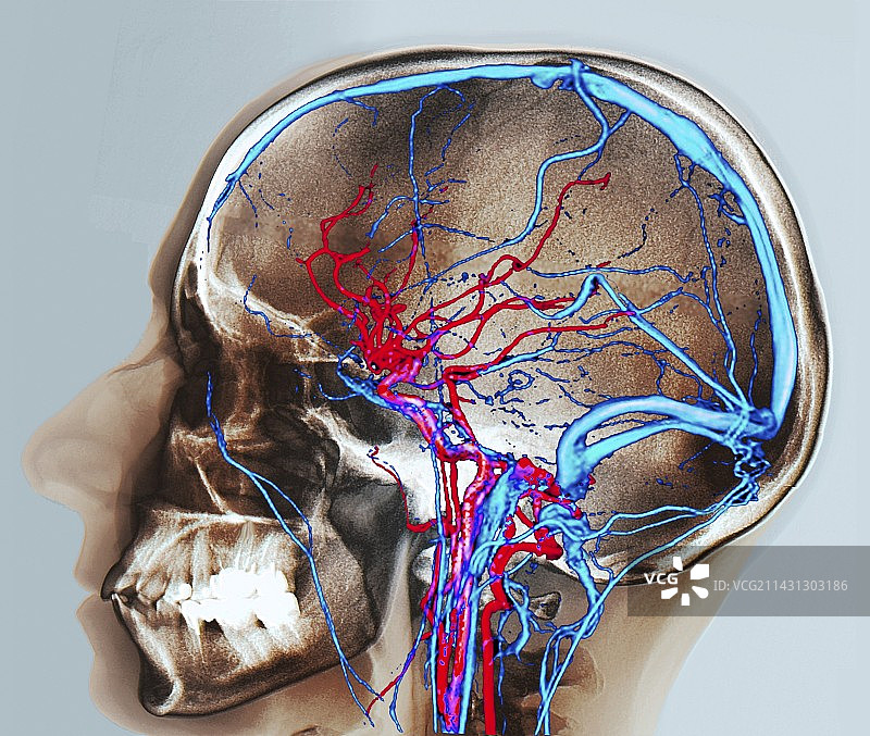 正常的大脑血液供应，CT扫描图片素材