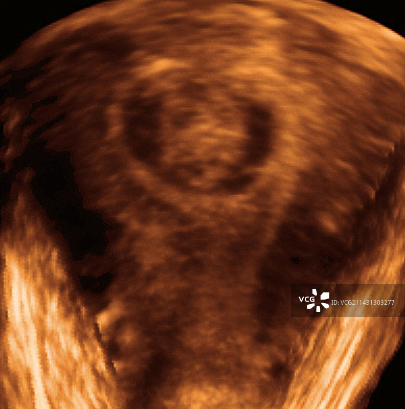 子宫肌瘤超声波扫描图片素材