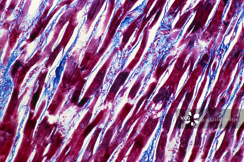 发炎心肌（心肌炎）图片素材