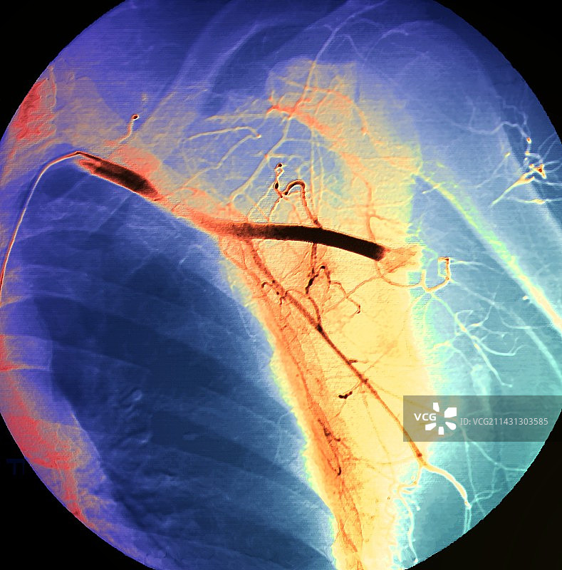 高安动脉炎，血管造影图片素材