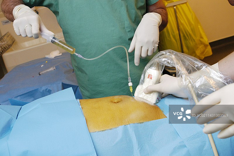 羊膜穿刺术图片素材