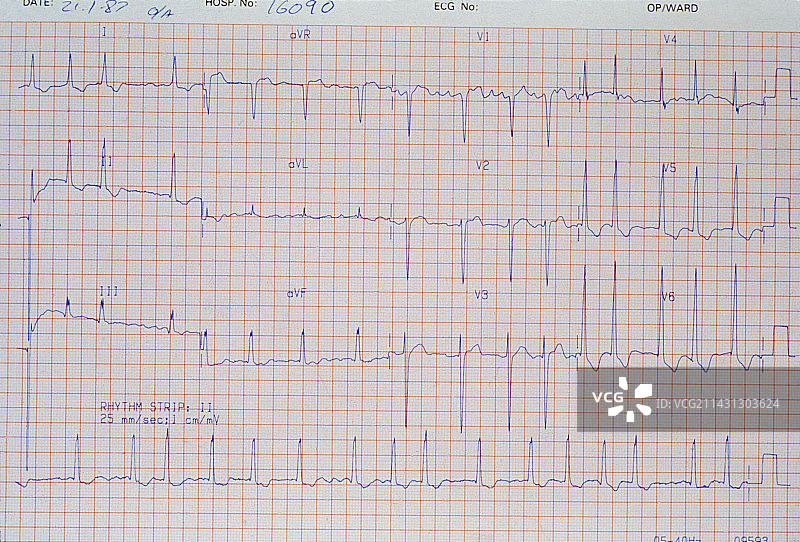 显示主动脉瓣狭窄的心电图图片素材