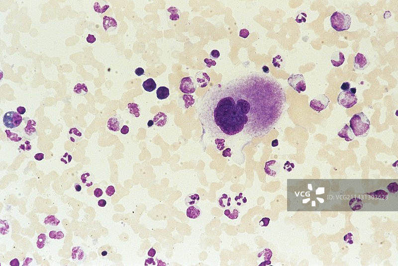 血小板减少症骨髓的LM图片素材