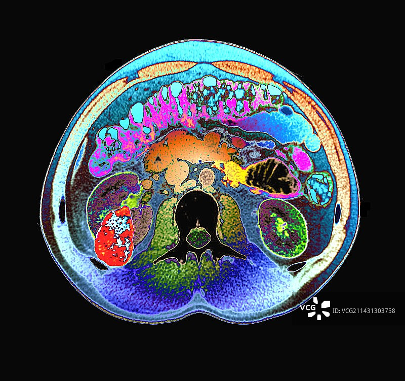 肾癌CT扫描图片素材