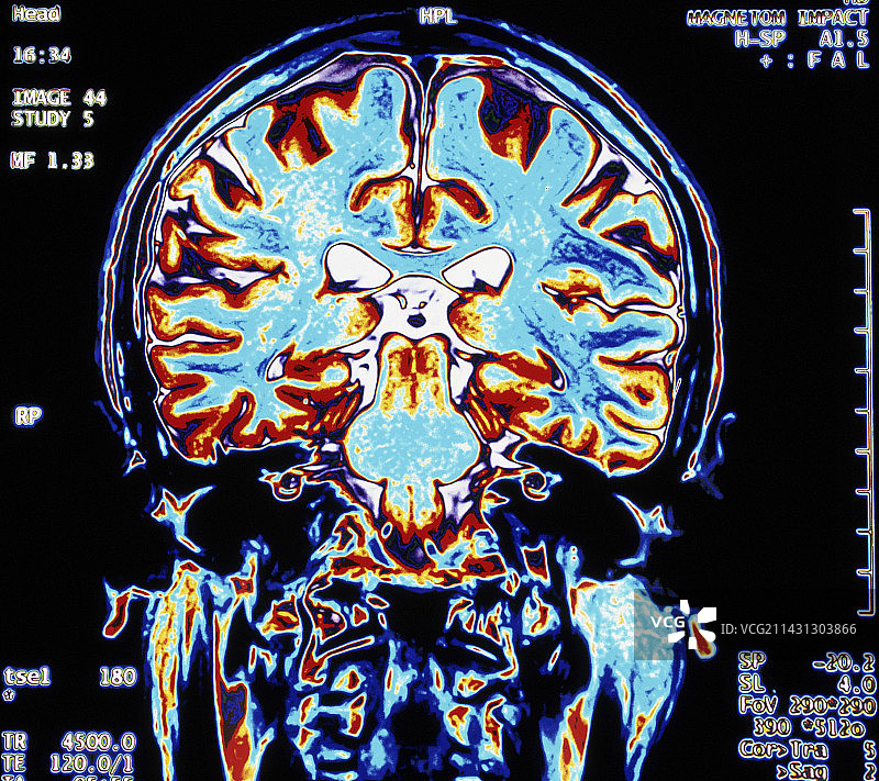大脑的彩色MRI扫描，冠状视图图片素材