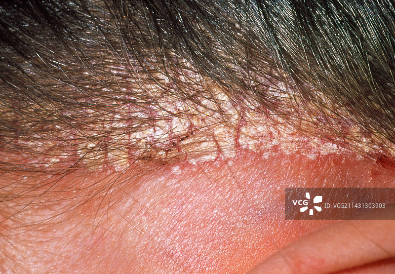 22岁女性头皮上的严重头皮屑图片素材