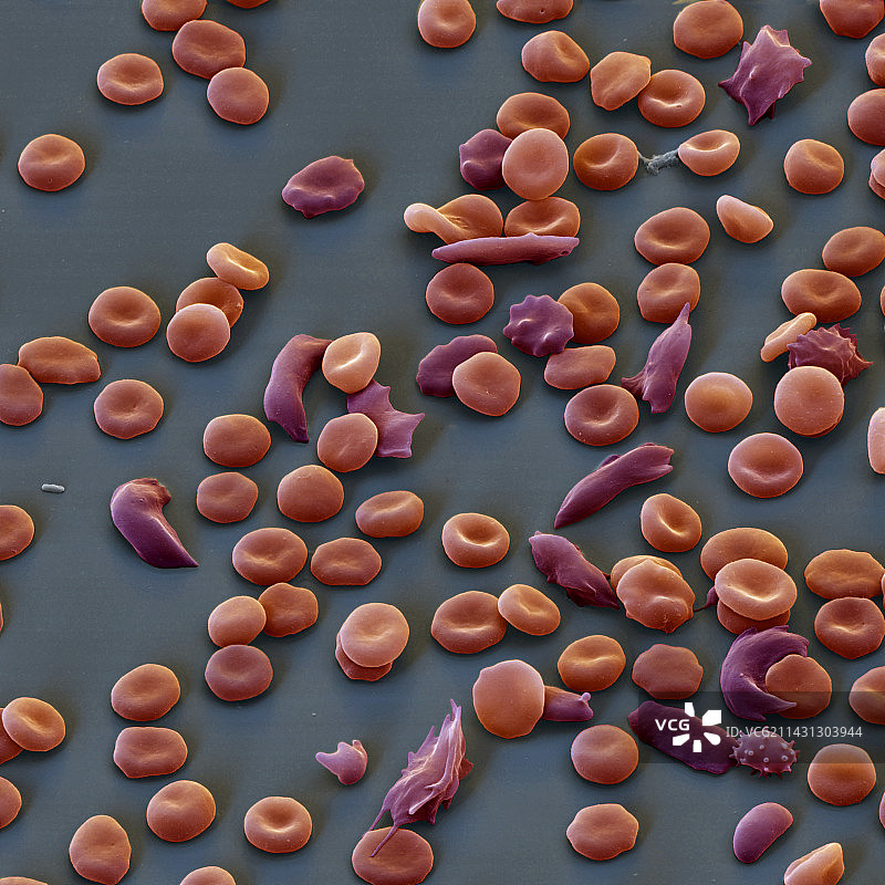 镰状细胞贫血症扫描电子显微镜图片素材