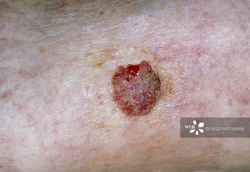 腿部皮肤鳞状细胞癌图片素材