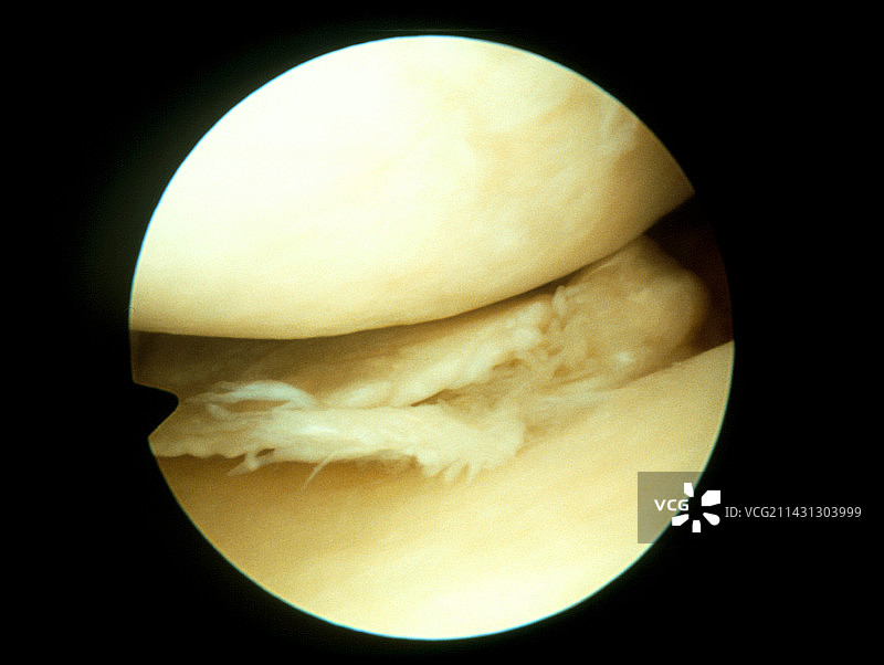 撕裂的膝盖半月板图片素材