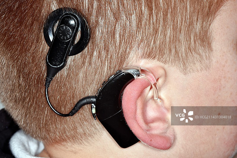 人工耳蜗图片素材