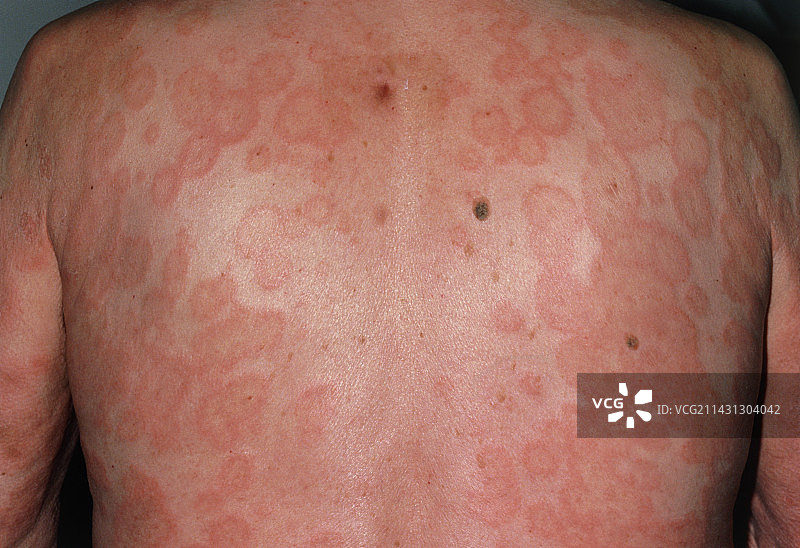 男性背部多形性红斑皮疹图片素材