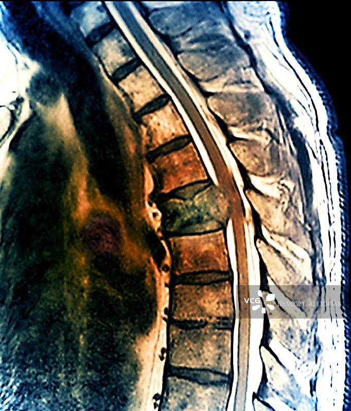 脊柱继发性骨癌的MRI扫描图片素材