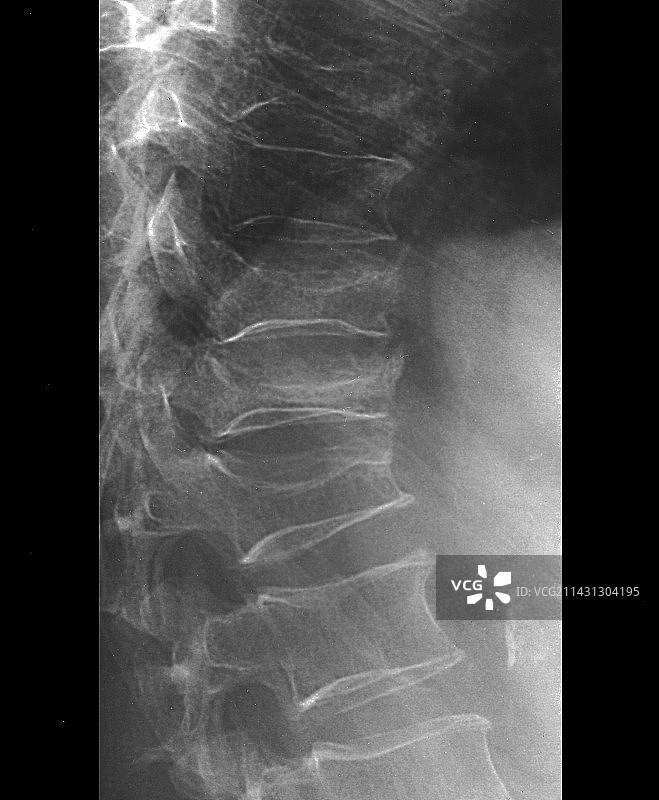 骨质疏松脊椎X光片图片素材
