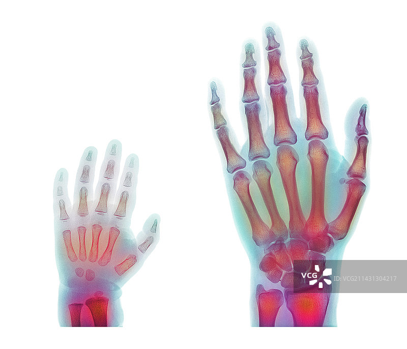 成人和儿童手部X光片图片素材