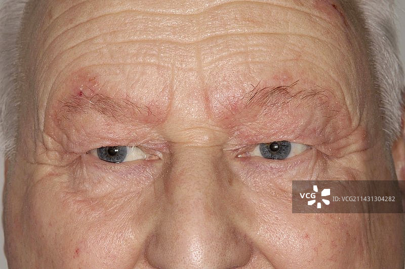 眼周的脂溢性皮炎图片素材