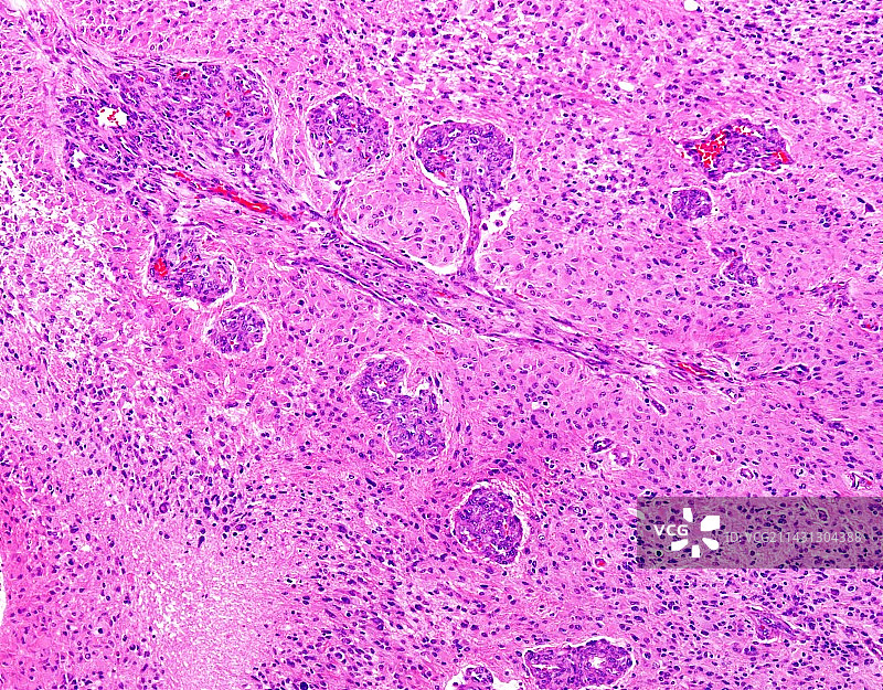 胶质母细胞瘤显微照片图片素材