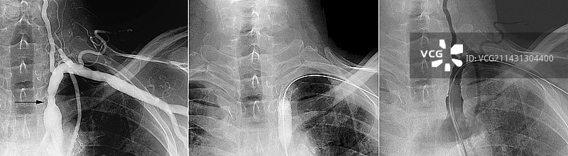 锁骨下动脉狭窄的治疗图片素材