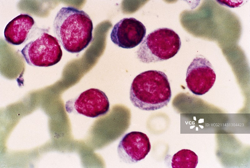 多发性骨髓瘤显微照片图片素材
