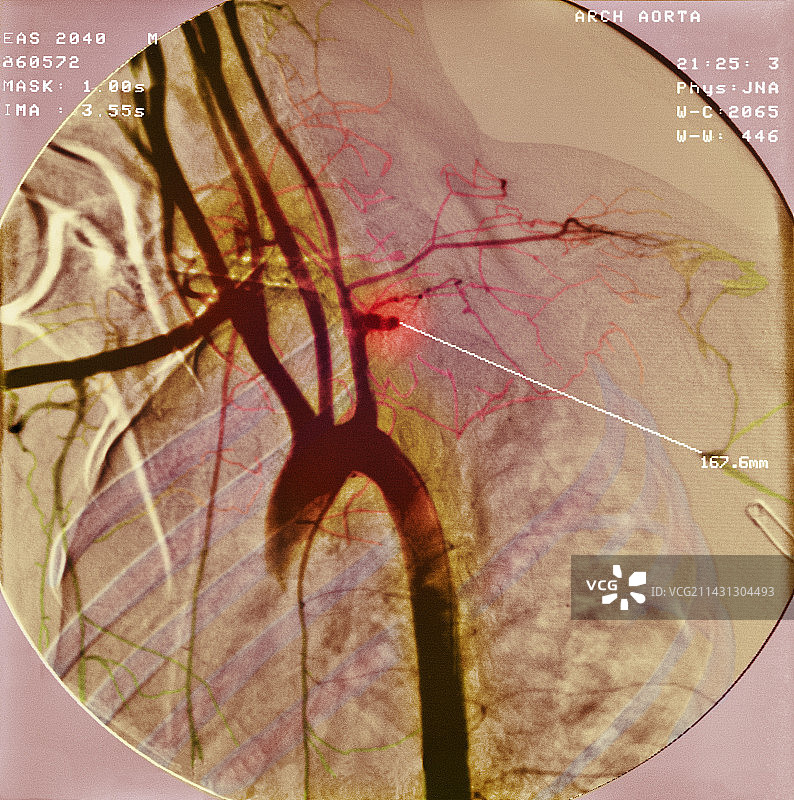 动脉阻塞X光片图片素材