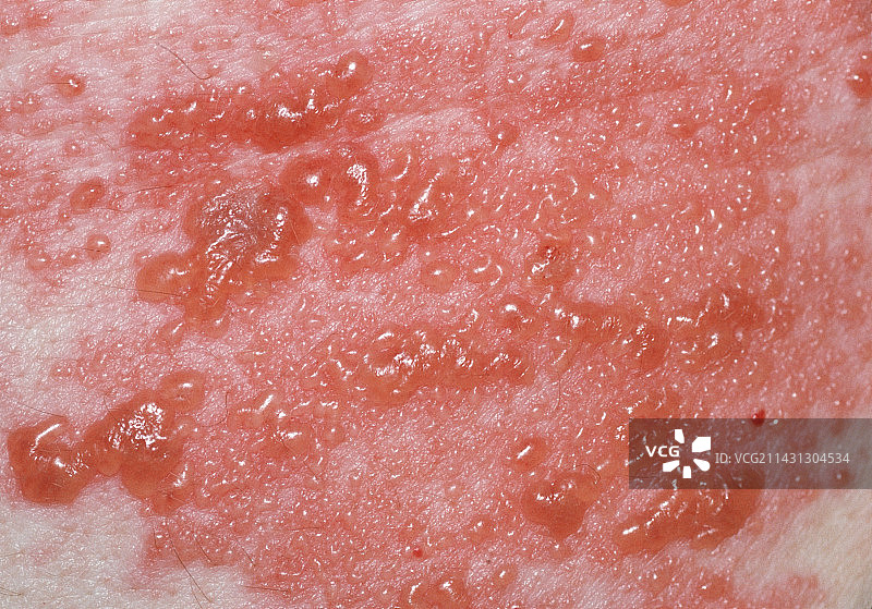 带状疱疹第二天图片素材