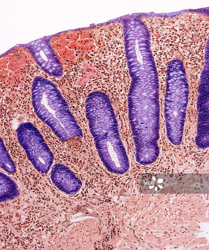 克罗恩病光学显微图像图片素材