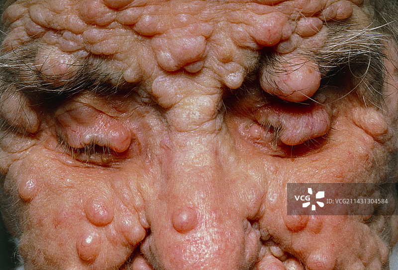 患有神经纤维瘤的女人面部图片素材